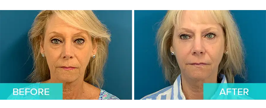 Laser Skin Resurfacing Boca Raton Lasabrasion